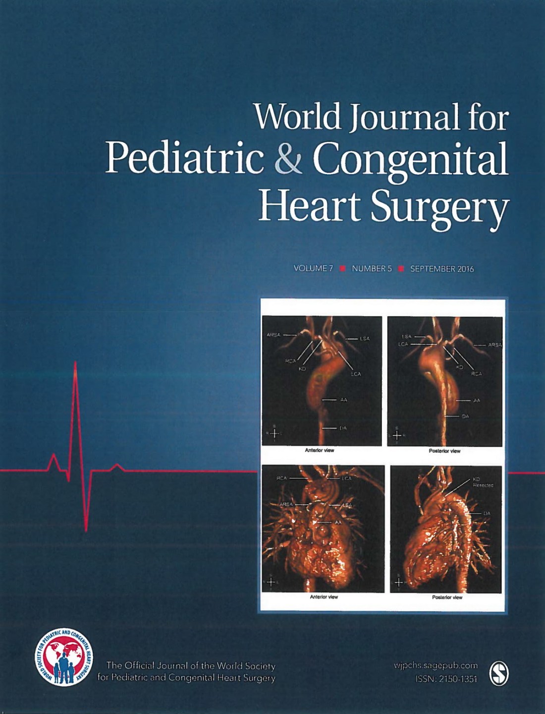 Single-Stage Total Arch Replacement Including Resection of Kommerell Diverticulum in a Patient With Loeys-Dietz Syndrome - World J Cover 1200px.jpg